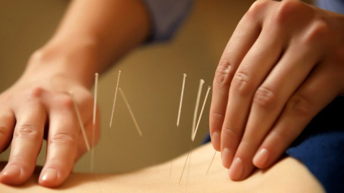 acupunctura